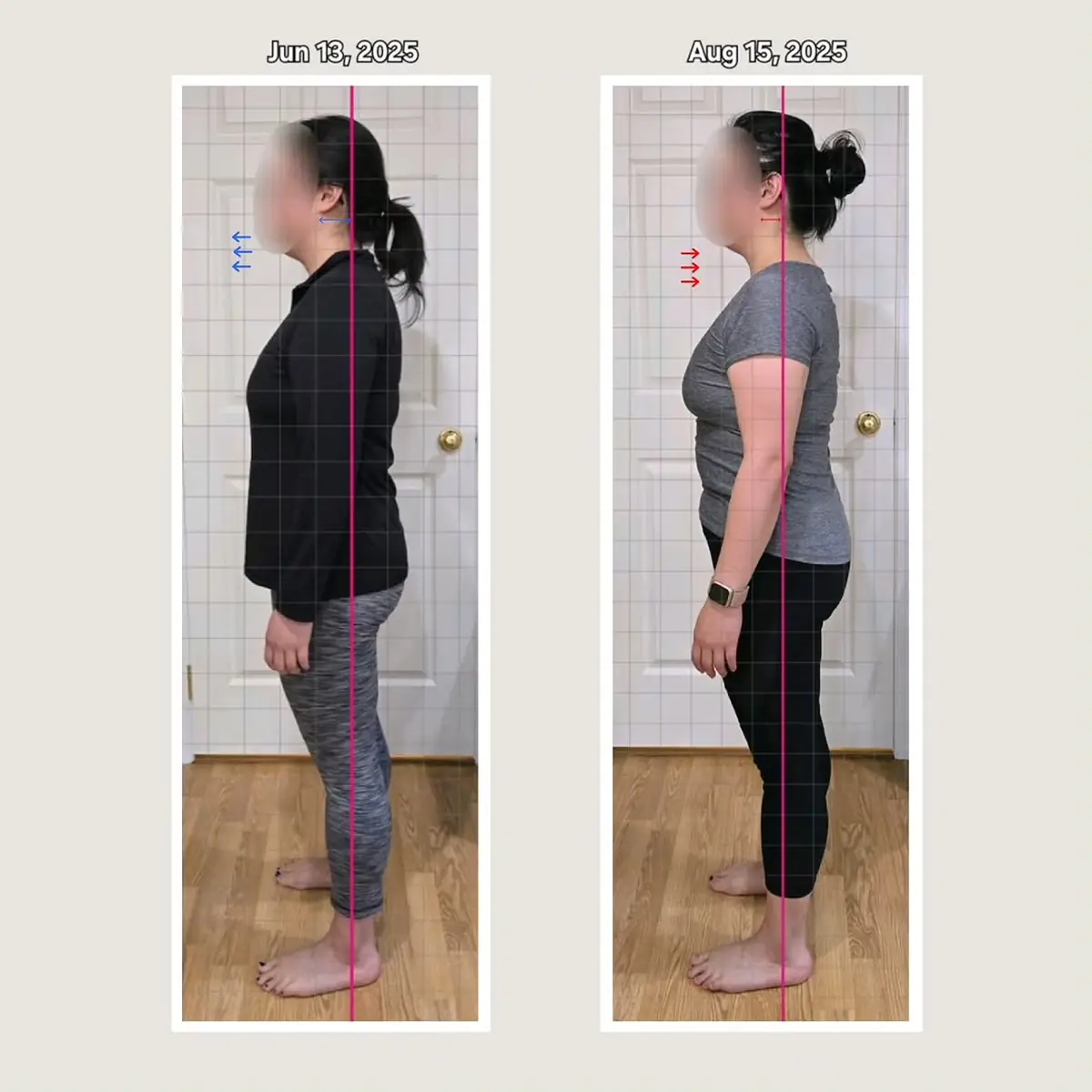 Client posture transformation before and after — rebuilding core strength and alignment after back surgery — tap to view on Instagram